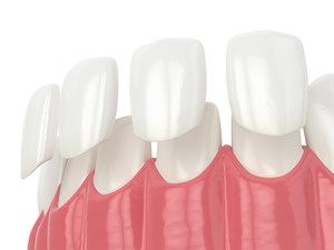 Illustration of four veneers being attached to four teeth